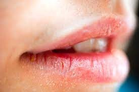 Angular-Cheilitis-1