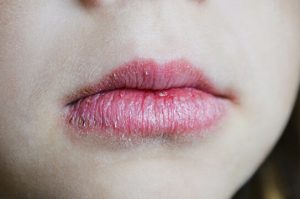 Angular-Cheilitis